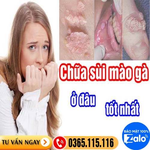 10 địa chỉ khám chữa bệnh sùi mào gà ở đâu Hà Nội tốt nhất