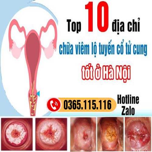 10 địa chỉ chữa viêm lộ tuyến cổ tử cung ở đâu tốt Hà Nội